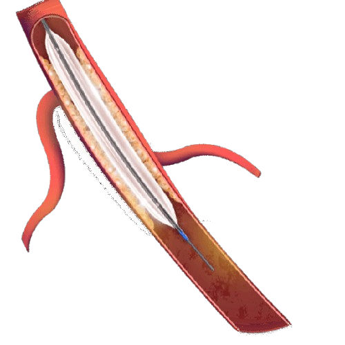 Tresfort™ 35 PTA Balloon Catheter