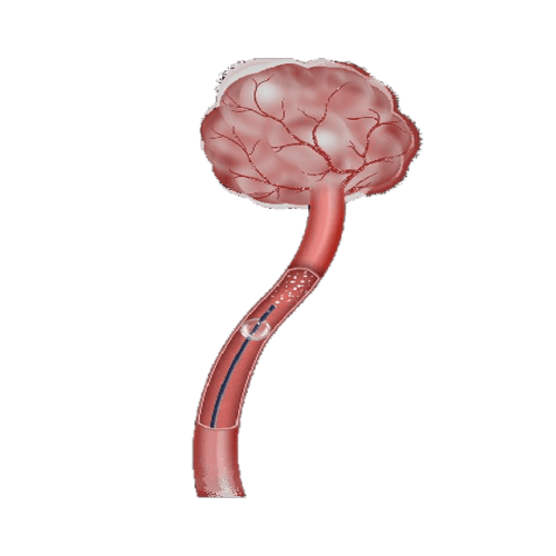 Distail™ Bonbon Balloon Occlusion Microcatheter